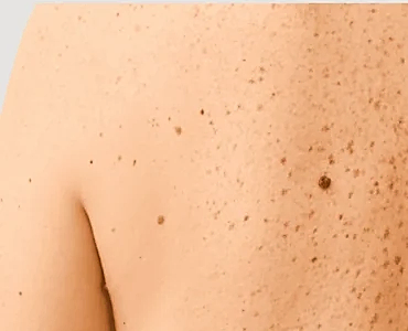 et beni tedavisi izmir