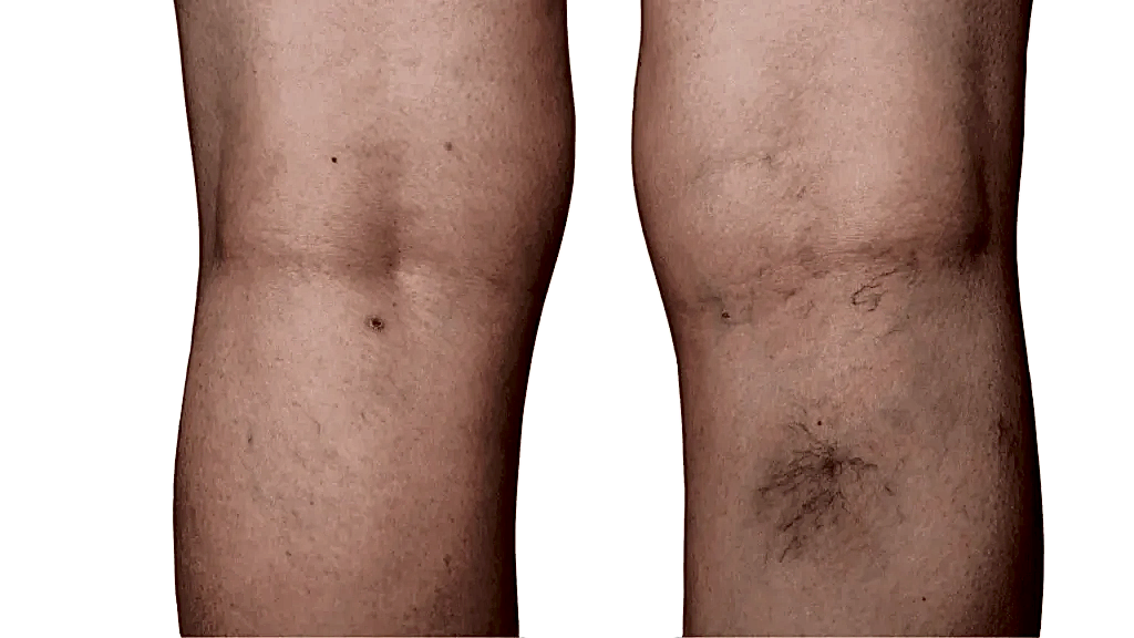 Kılcal Damar Tedavisi