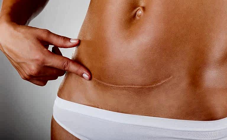 Ameliyat İzleri Tedavisi