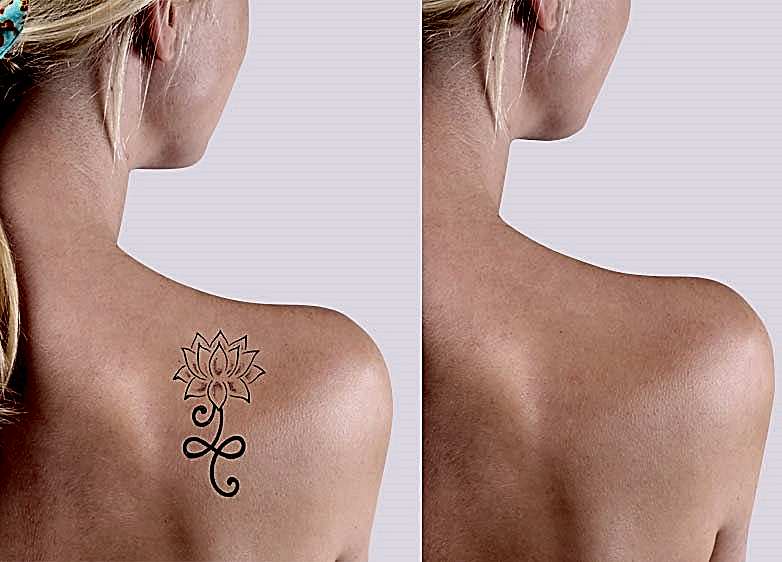 Dövme Silme Uygulaması 1 Dövme Silme Uygulaması