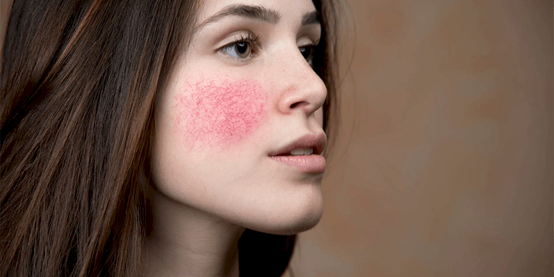 Kırmızı Yüz Tedavisi 1 Kırmızı Yüz Tedavisi