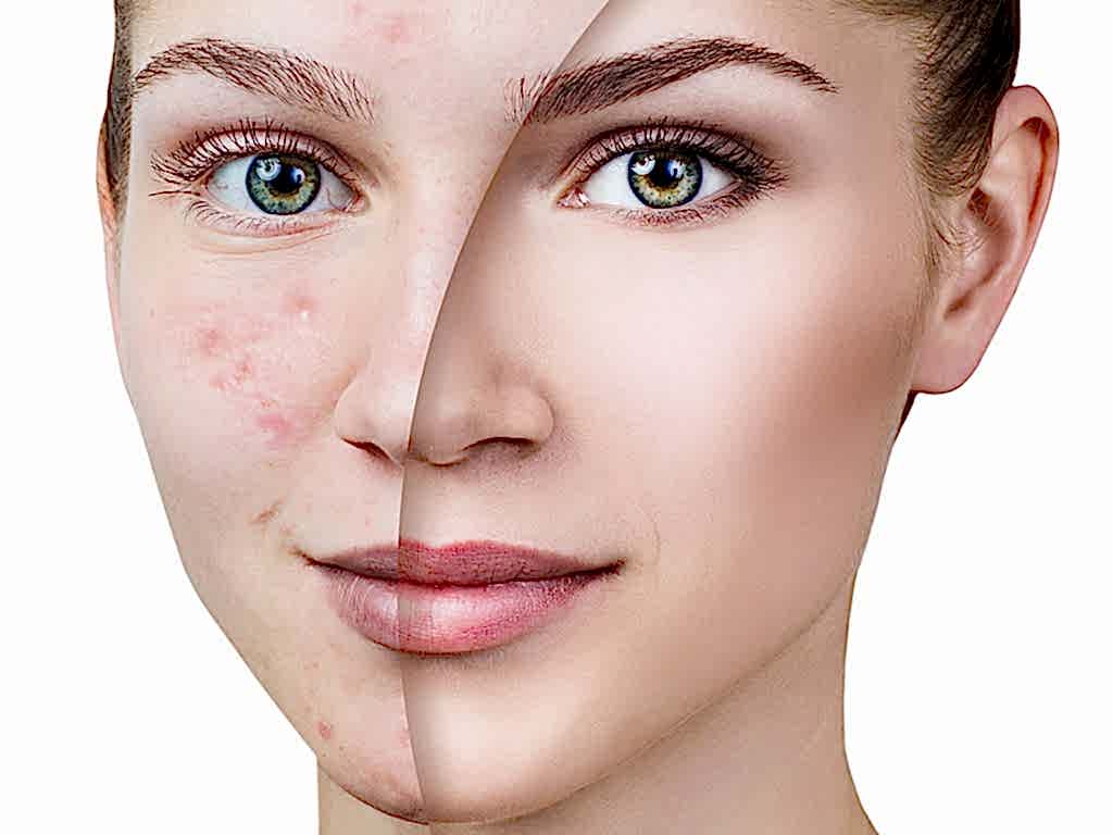 Melasma Tedavisi 1 Melasma Tedavisi