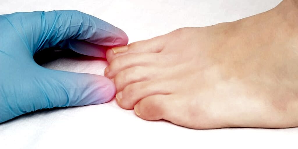 Tırnak Mantarı Tedavisi