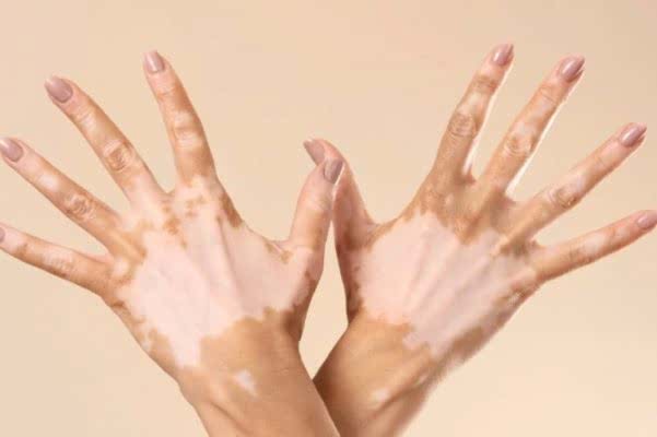 Vitiligo Tedavisi 1 Vitiligo Tedavisi