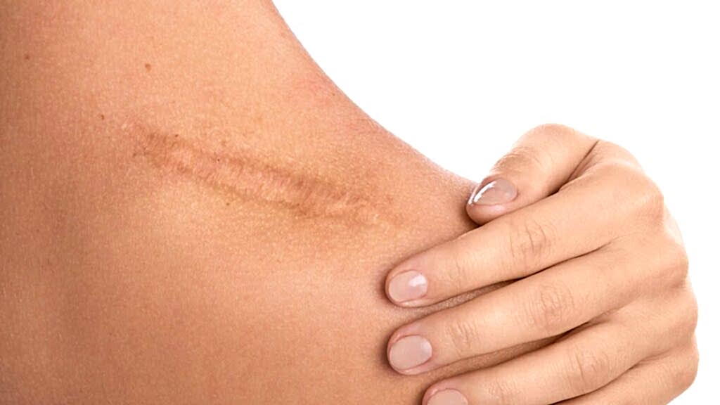 Yara İzi (Skar) Tedavisi